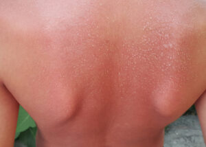Altitude Sickness Sunburn